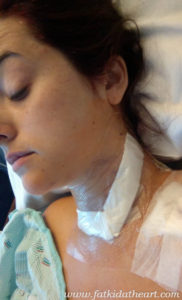 Day of surgery. Modified radical neck dissection. The surgeons removed my whole thyroid and 30 lymph nodes.