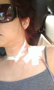 Three Days Post-Surgery. They send you home with a disgusting 'drain tube' that they will later rip out at a post-surgery check up - be fair-warned!